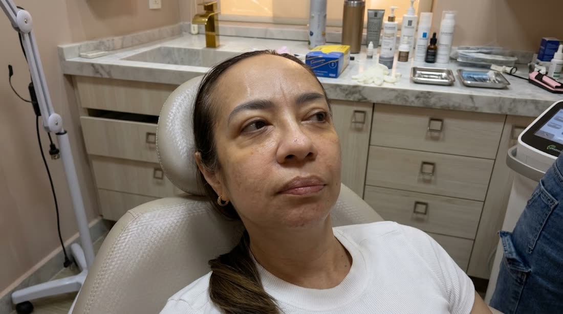Antes da harmonização facial