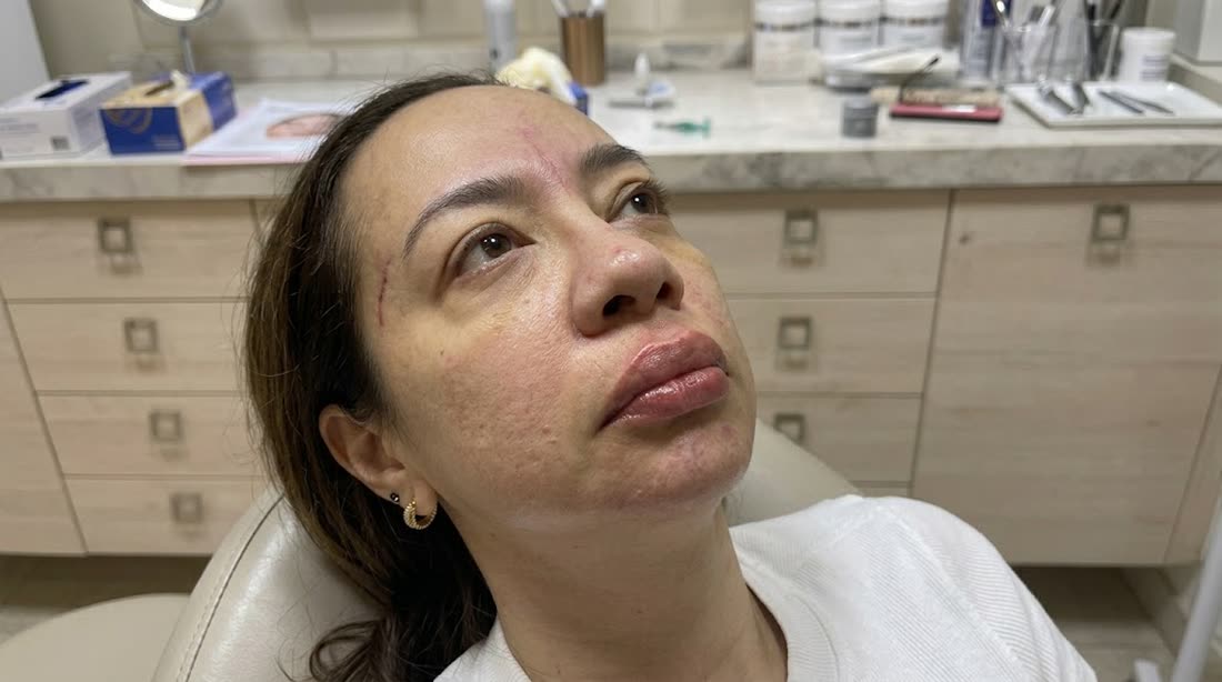 Rosto depois da harmonização facial