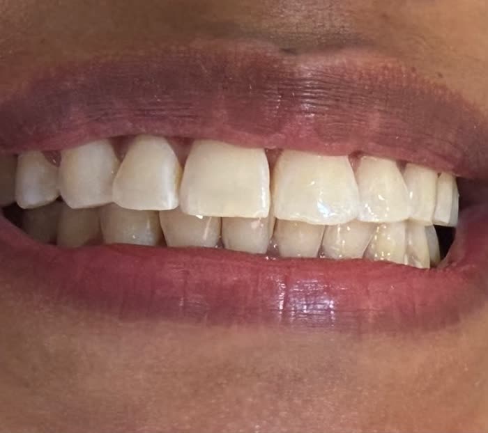 Antes do clareamento dental