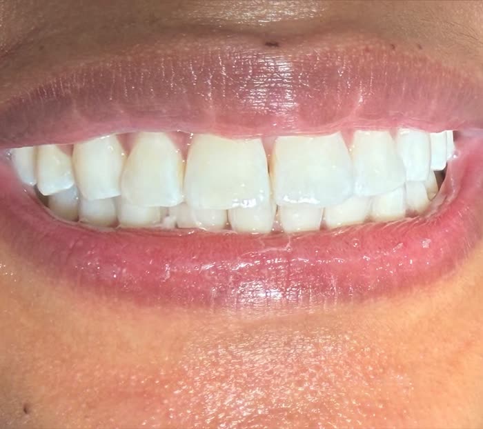 Depois do clareamento dental