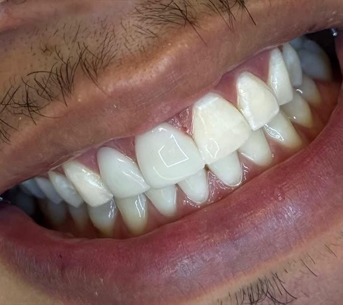 Depois do clareamento com restauração