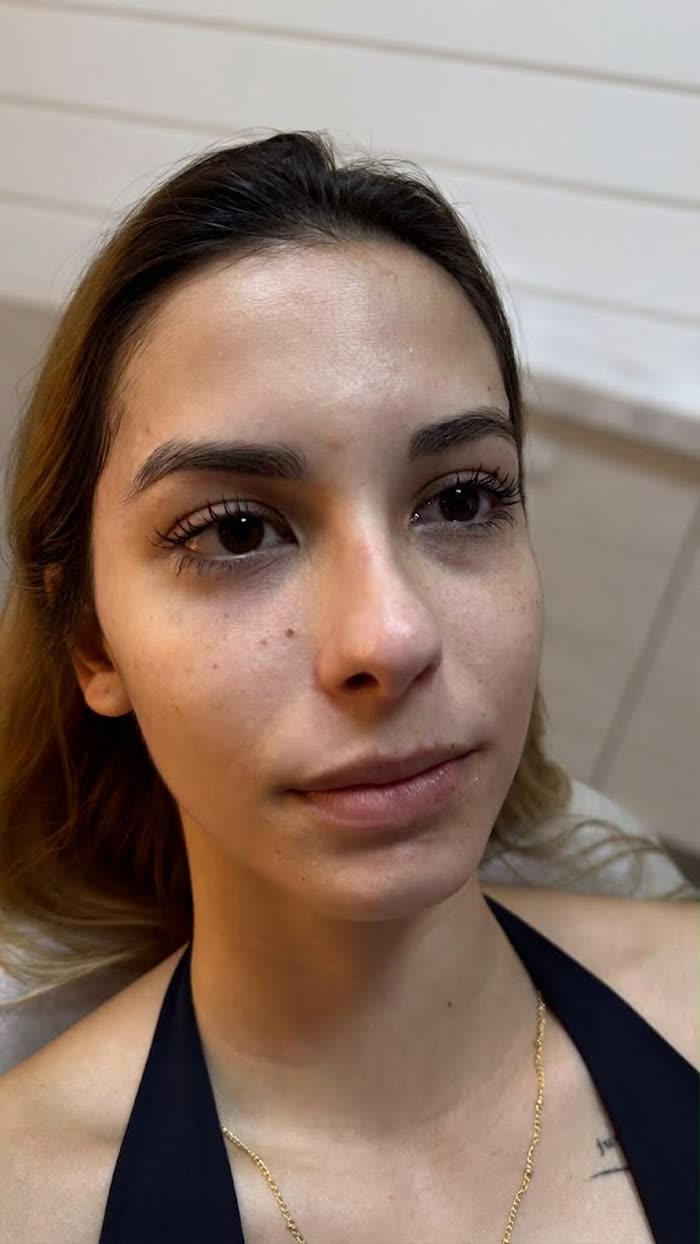 Antes do preenchimento labial