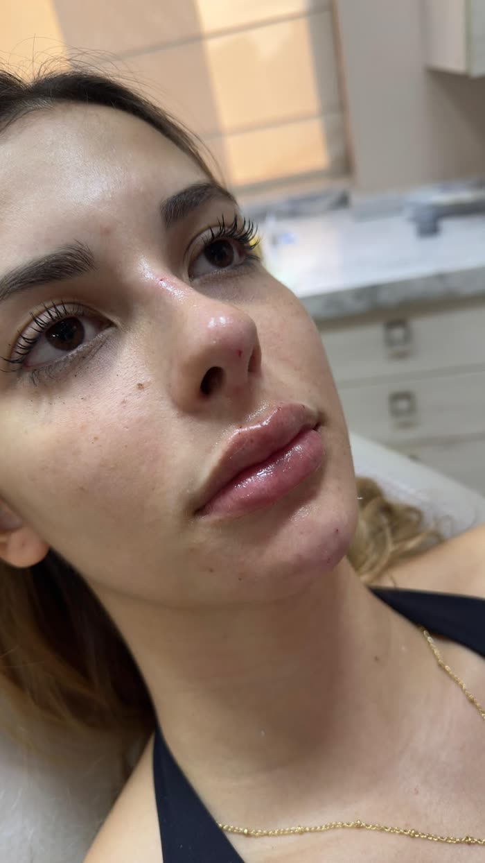Depois do preenchimento labial