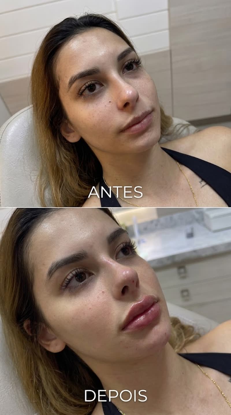Antes e depois de preenchimento labial de paciente atendida pela Dra. Marillya Vitória